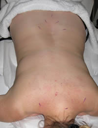 Acupuncture for low back pain and base of neck pain